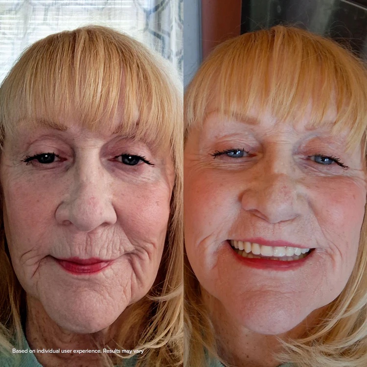 Before and after using the CPAP Peptide Serum