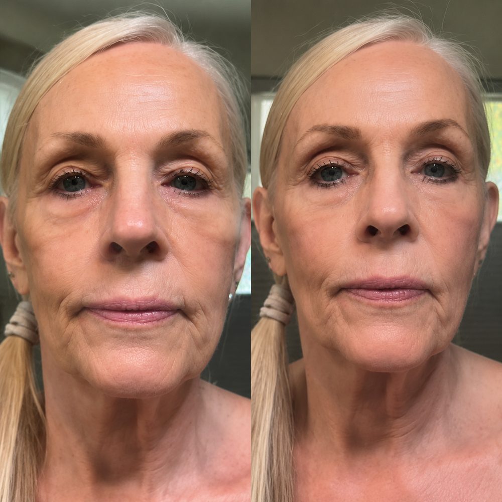 Cheryl before and after using TECA Skin Repair Cream