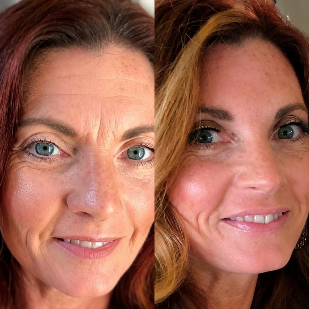 Diane before and after using TECA Skin Repair Cream