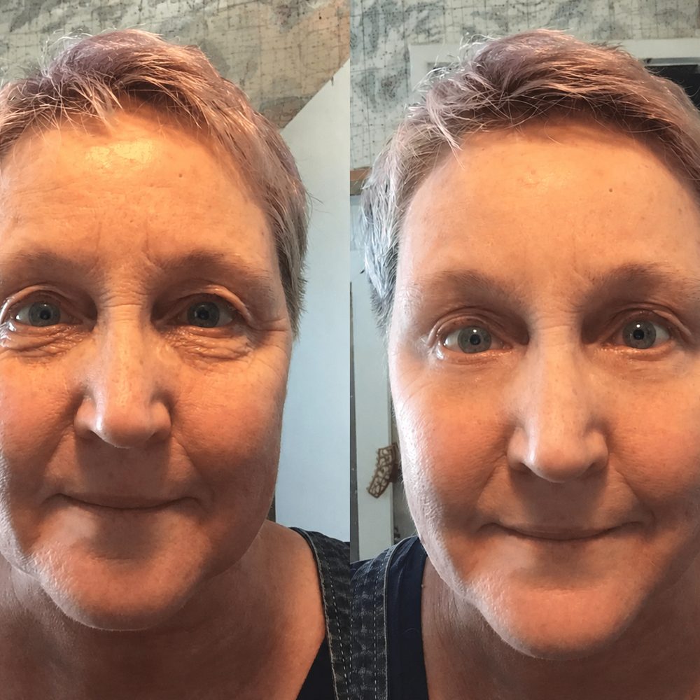 Karen before and after using TECA Skin Repair Cream