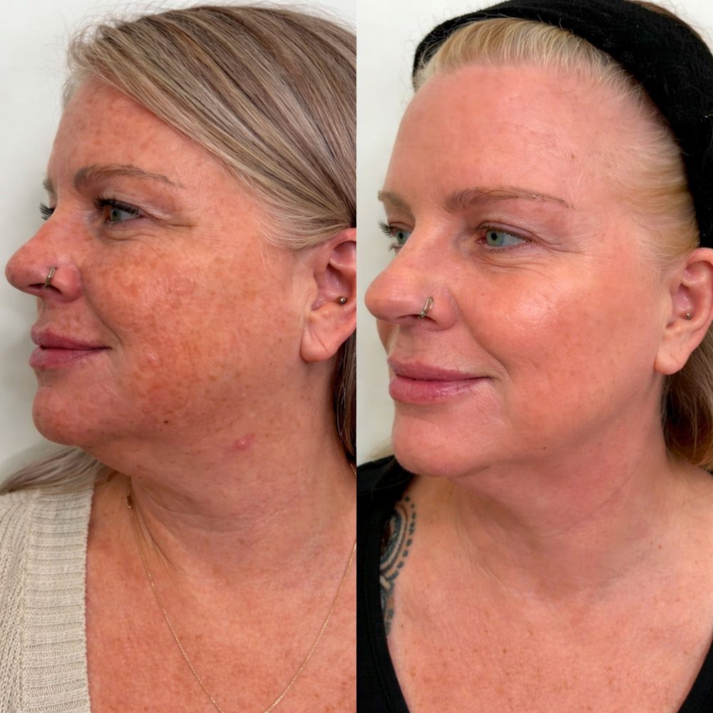 Linda before and after using TECA Skin Repair Cream for sun spots and hyperpigmentation