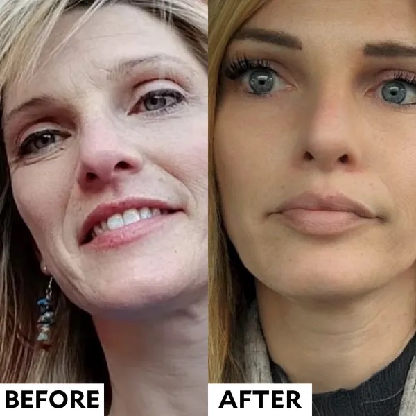 Before and after smile lines