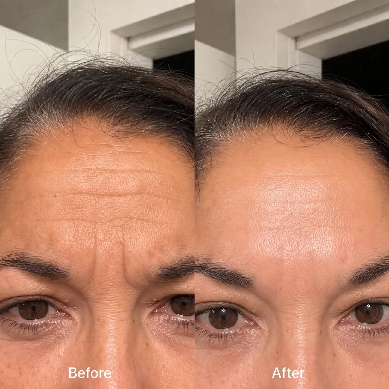 Before and after: smoother forehead skin