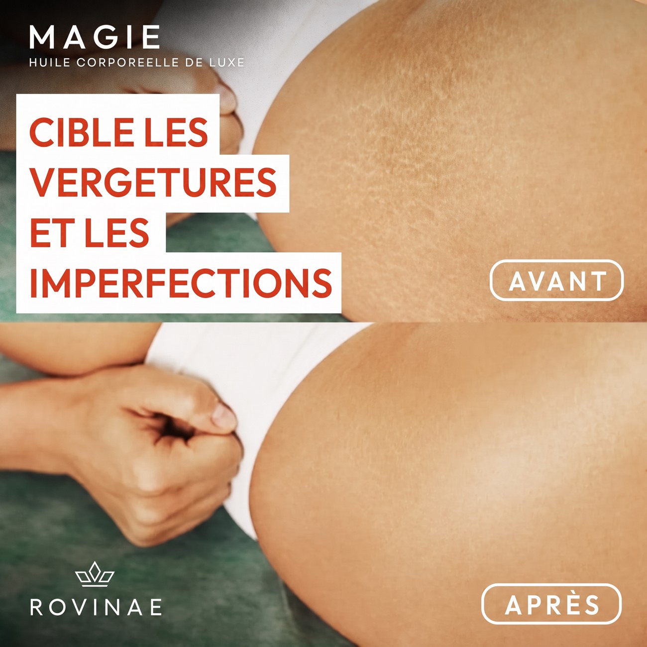 Cible les vergetures et les imperfections
